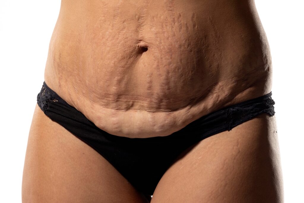 Woman,With,Loose,Skin,And,Stretch,Marks,On,Her,Belly
