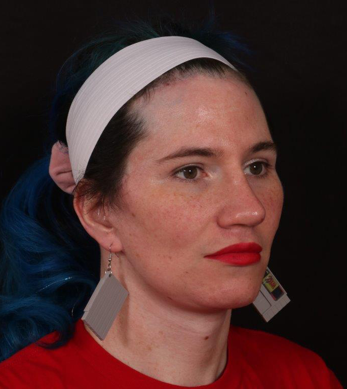 After Image: FFS (Facial Feminization Surgery) - right-front-oblique