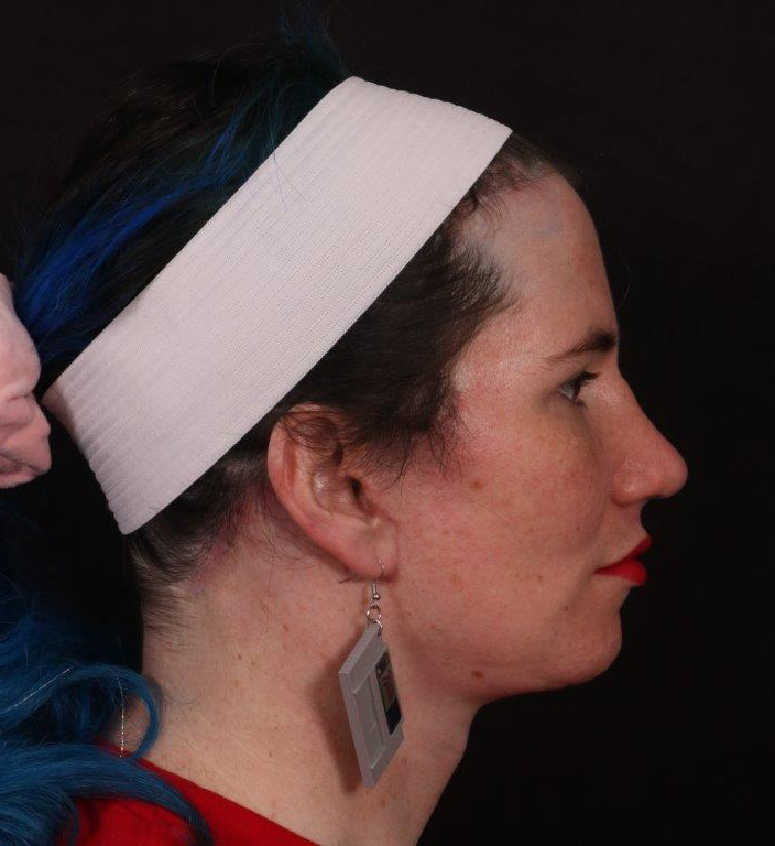 After Image: FFS (Facial Feminization Surgery) - right-side