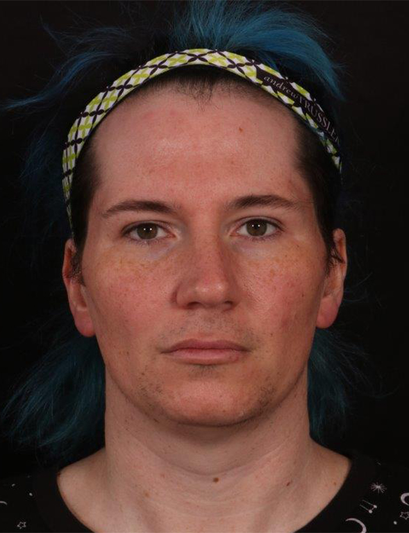 Before Image: FFS (Facial Feminization Surgery) - front