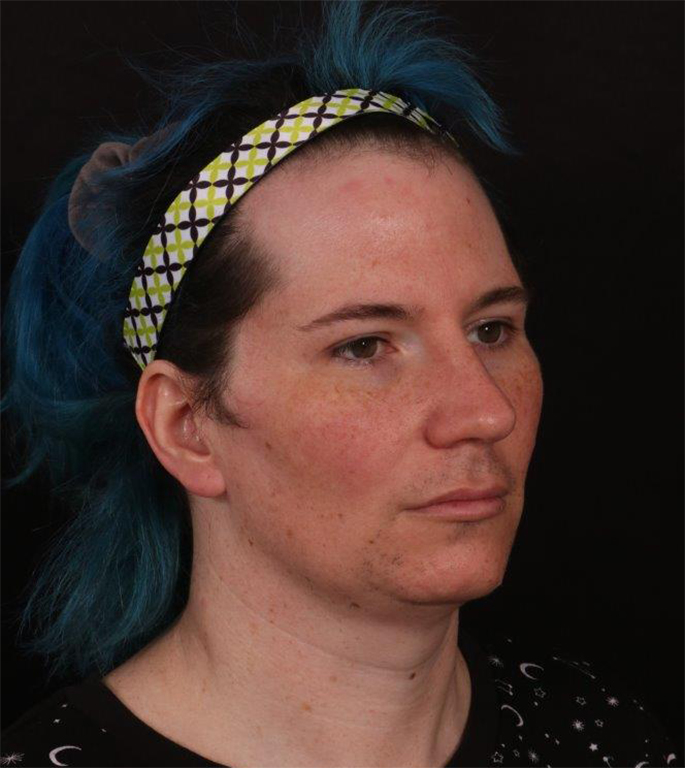 Before Image: FFS (Facial Feminization Surgery) - right-front-oblique