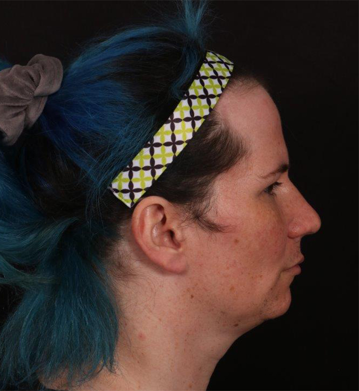 Before Image: FFS (Facial Feminization Surgery) - right-side