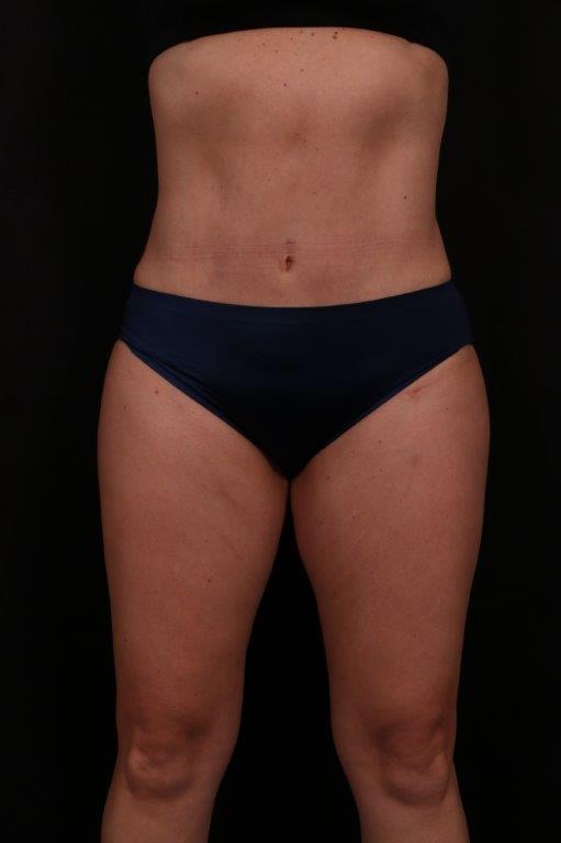After Image: Mini Tummy Tuck (Abdominoplasty) - front