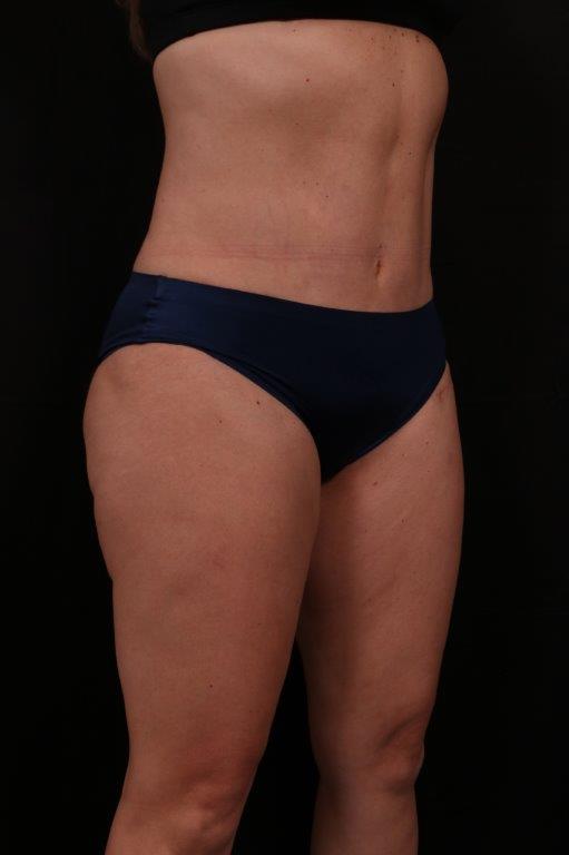 After Image: Mini Tummy Tuck (Abdominoplasty) - right-front-oblique