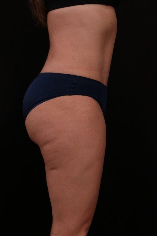After Image: Mini Tummy Tuck (Abdominoplasty) - right-side