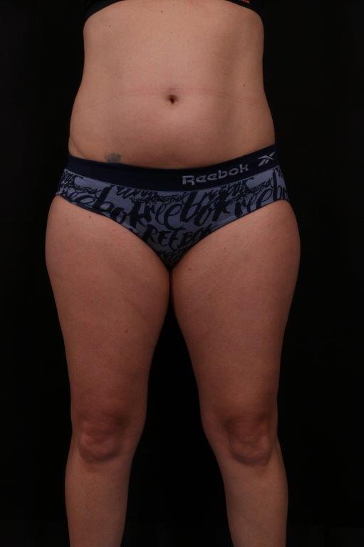 Before Image: Mini Tummy Tuck (Abdominoplasty) - front