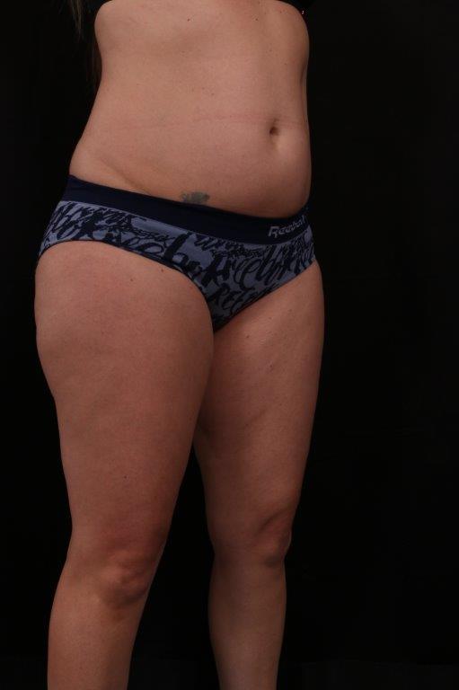 Before Image: Mini Tummy Tuck (Abdominoplasty) - right-front-oblique