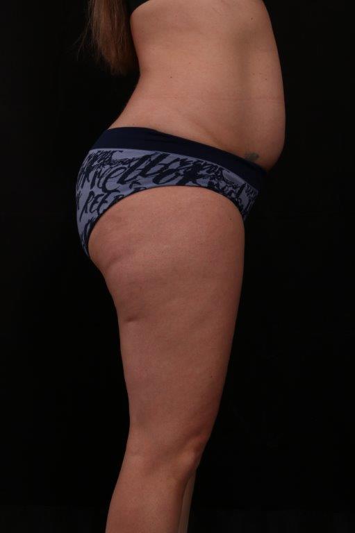 Before Image: Mini Tummy Tuck (Abdominoplasty) - right-side