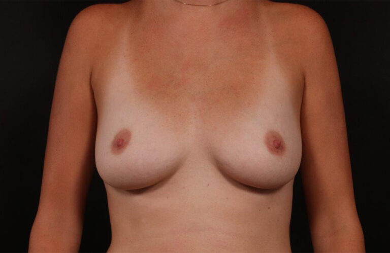 Before Image: Breast Augmentation - front