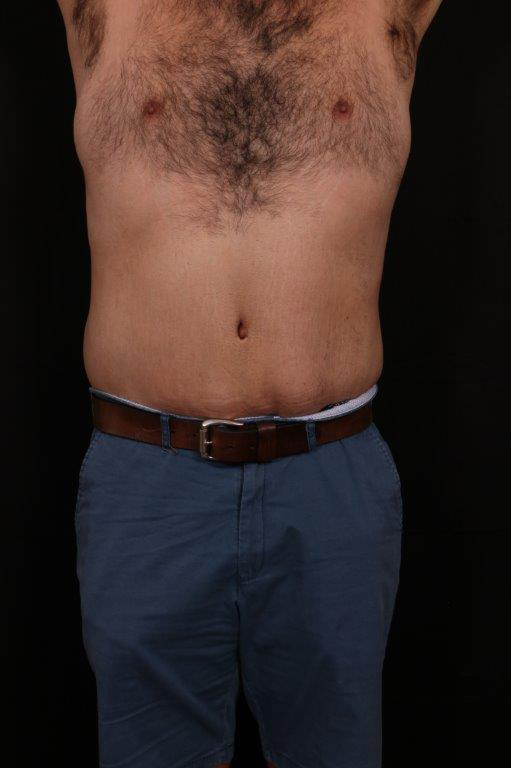 After Image: Body Lift - front