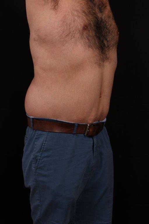 After Image: Body Lift - right-front-oblique