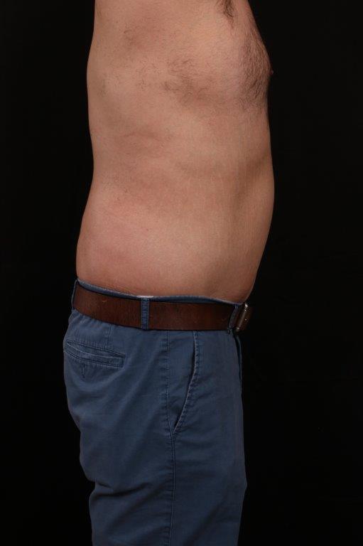 After Image: Body Lift - right-side