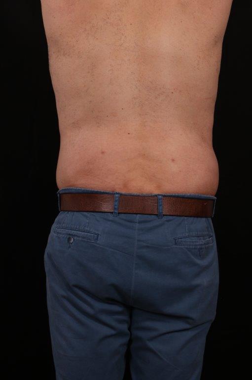 After Image: Body Lift - back