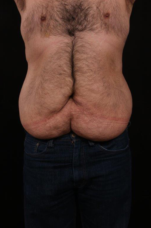 Before Image: Body Lift - front