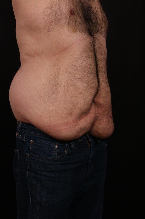 Before Image: Body Lift - right-front-oblique