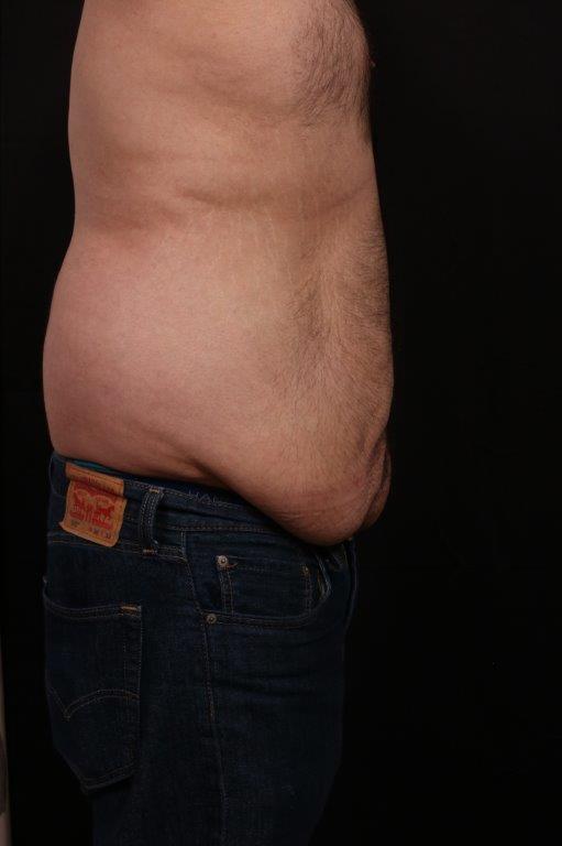 Before Image: Body Lift - right-side