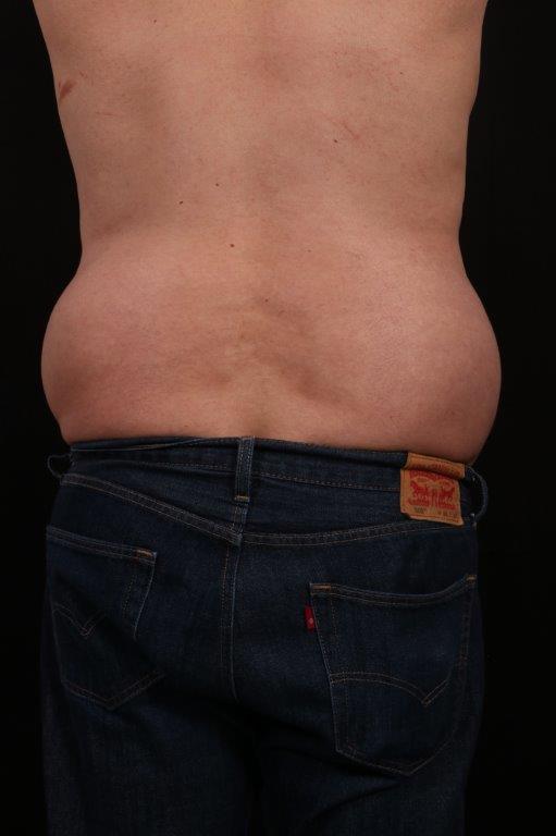 Before Image: Body Lift - back