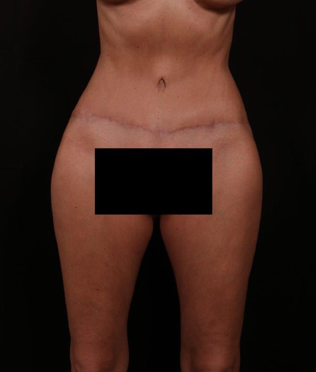 After Image: Tummy Tuck - front