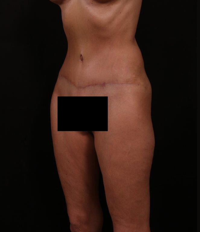 After Image: Tummy Tuck - left-front-oblique