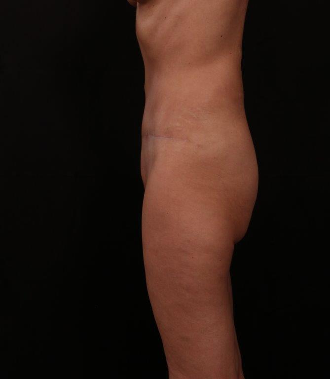 After Image: Tummy Tuck - left-side