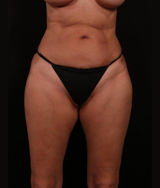 Before Image: Tummy Tuck - front