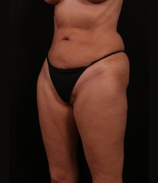 Before Image: Tummy Tuck - left-front-oblique