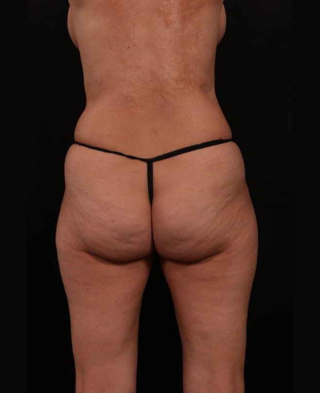Before Image: Tummy Tuck - back