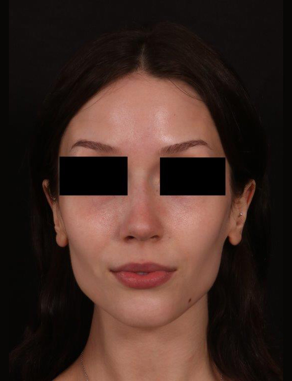 After Image: Rhinoplasty - front