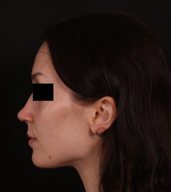After Image: Rhinoplasty - left-side