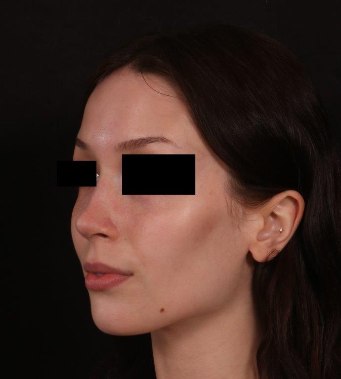 After Image: Rhinoplasty - left-front-oblique