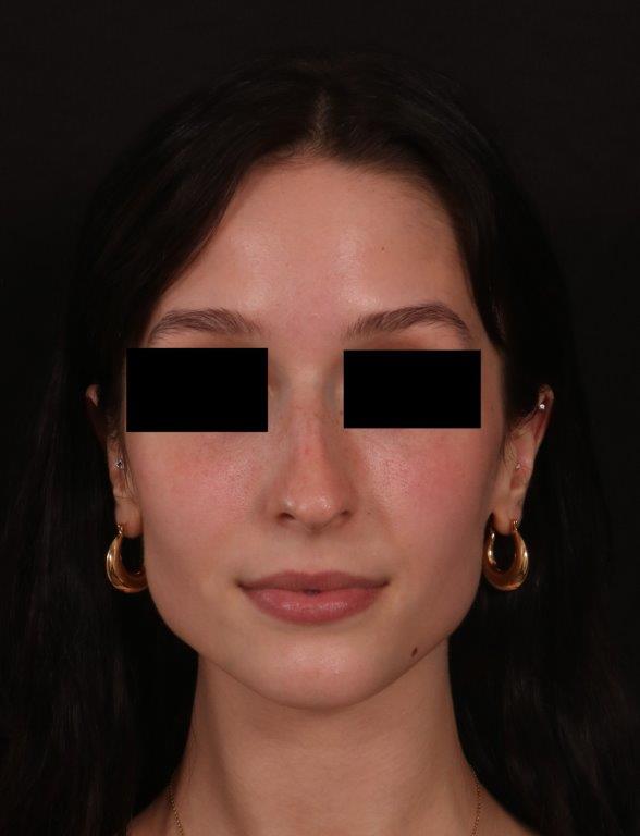 Before Image: Rhinoplasty - front