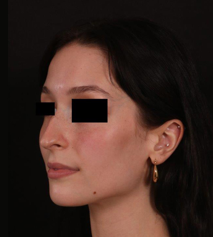 Before Image: Rhinoplasty - left-front-oblique