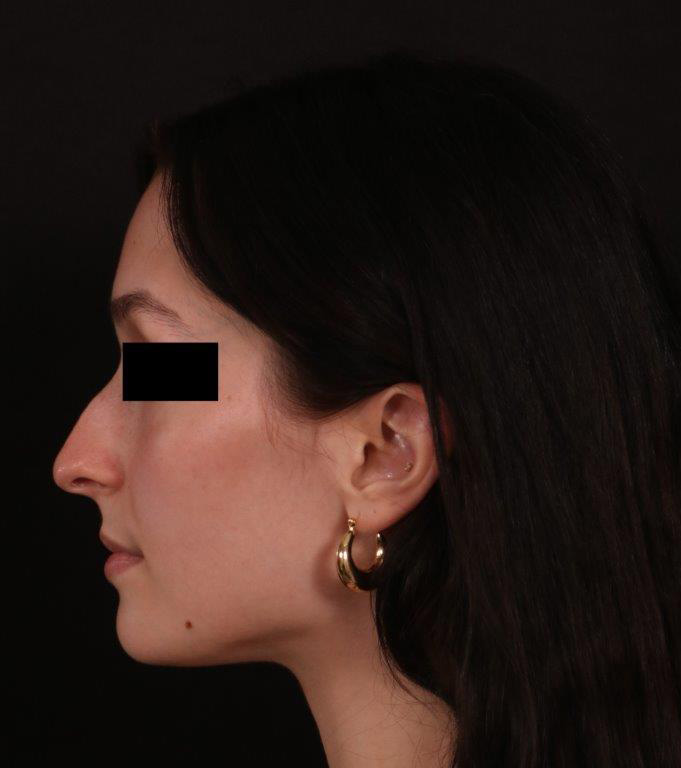 Before Image: Rhinoplasty - left-side