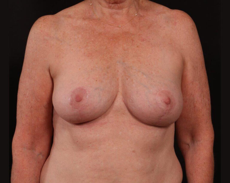 After Image: Mastopexy (Breast Lift) - front