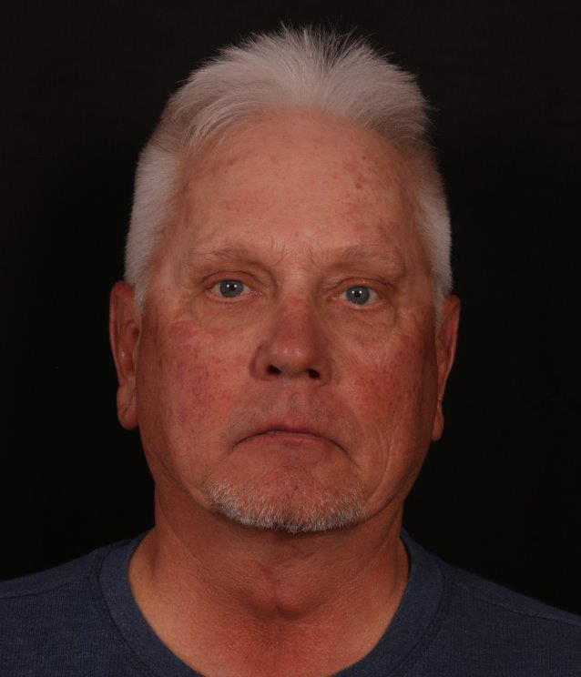 After Image: Male Neck Lift, Brow lift and Blepharoplasty - front