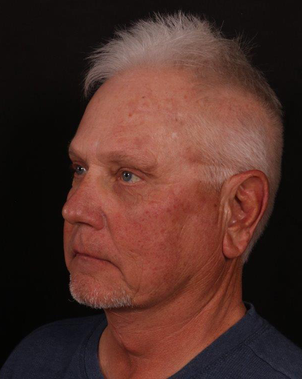 After Image: Male Neck Lift, Brow lift and Blepharoplasty - left-front-oblique