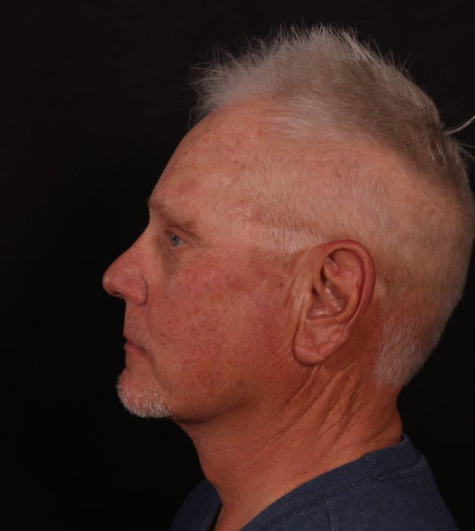 After Image: Male Neck Lift, Brow lift and Blepharoplasty - left-side