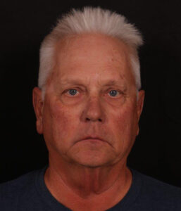 Before Image: Male Neck Lift, Brow lift and Blepharoplasty