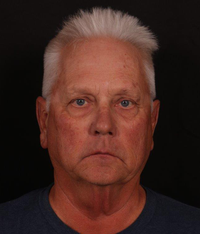 Before Image: Male Neck Lift, Brow lift and Blepharoplasty - front