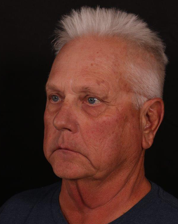 Before Image: Male Neck Lift, Brow lift and Blepharoplasty - left-front-oblique
