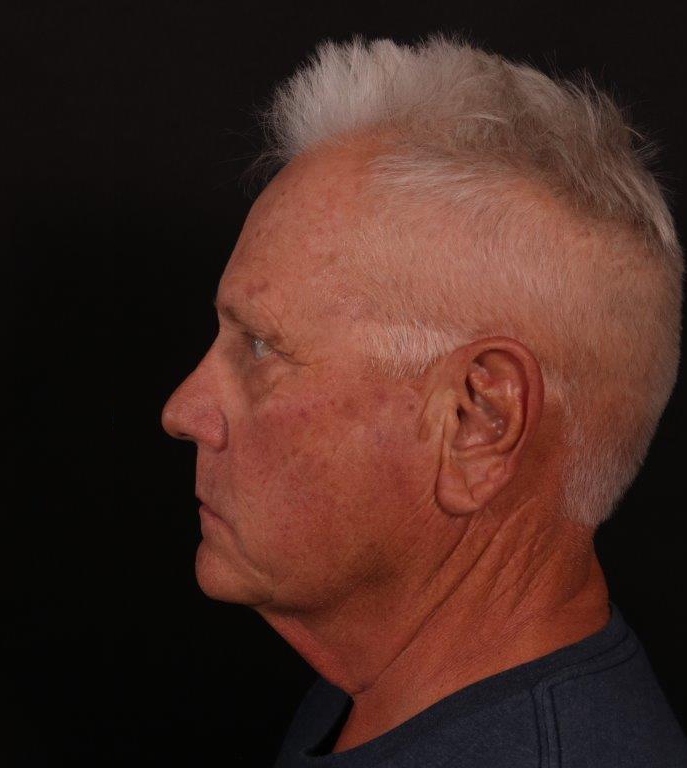 Before Image: Male Neck Lift, Brow lift and Blepharoplasty - left-side