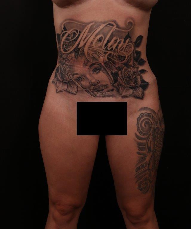 After Image: Tummy Tuck (Abdominoplasty) - front