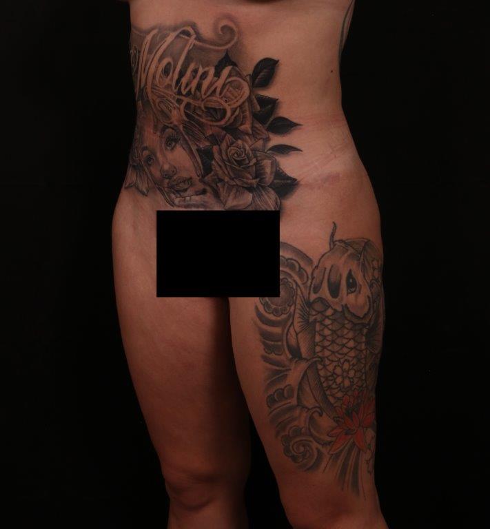 After Image: Tummy Tuck (Abdominoplasty) - left-front-oblique