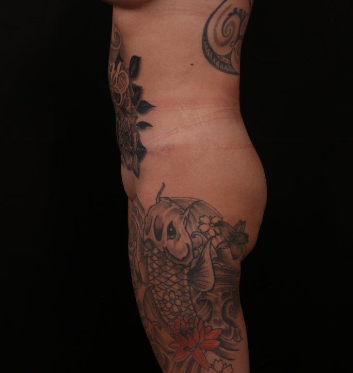 After Image: Tummy Tuck (Abdominoplasty) - left-side