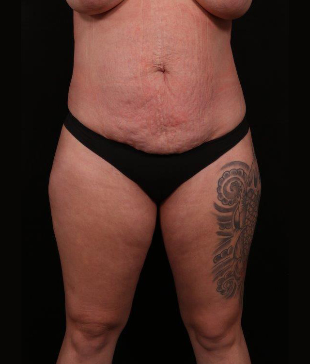 Before Image: Tummy Tuck (Abdominoplasty) - front