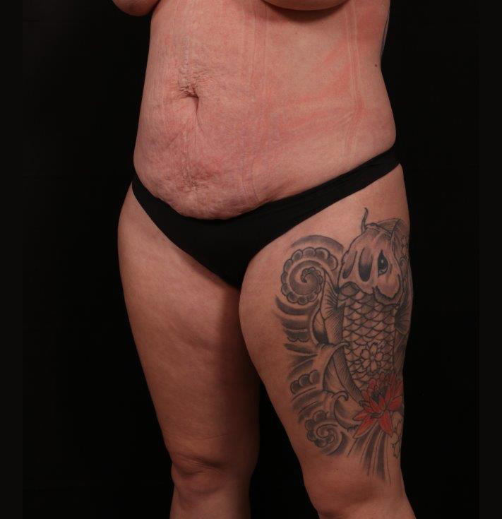 Before Image: Tummy Tuck (Abdominoplasty) - left-front-oblique