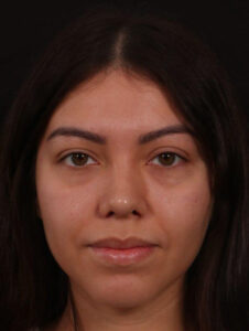 After Image: Revision Rhinoplasty