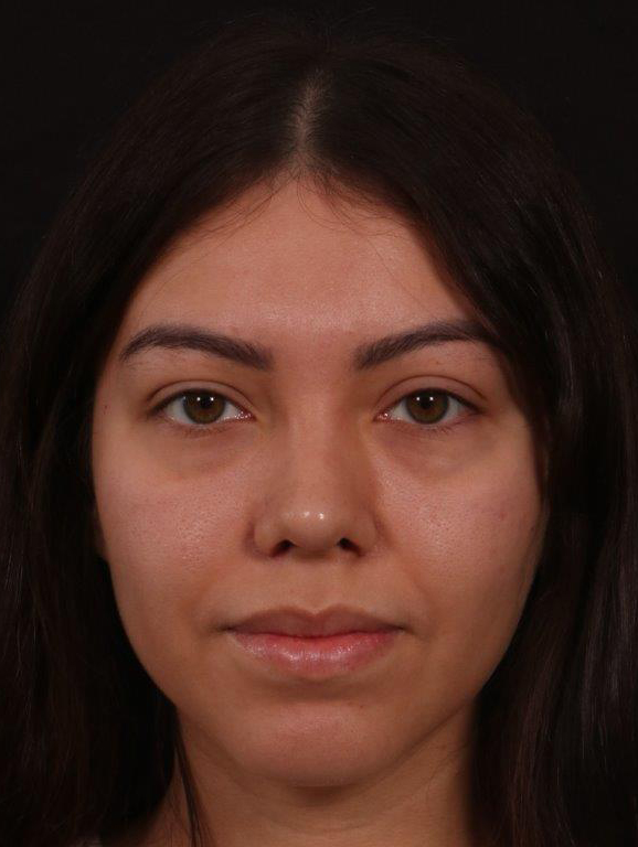 After Image: Revision Rhinoplasty - front