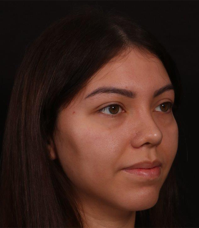 After Image: Revision Rhinoplasty - right-front-oblique