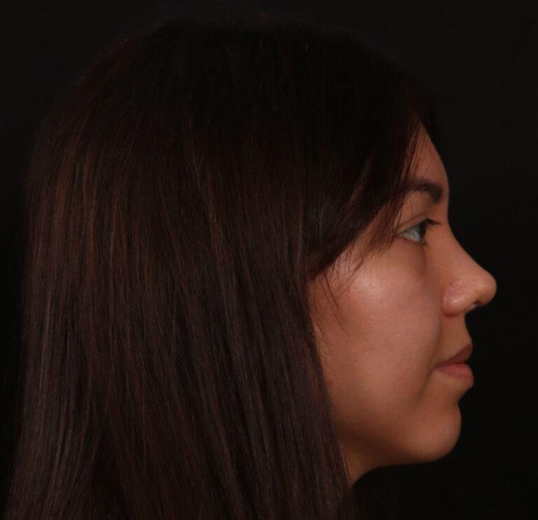After Image: Revision Rhinoplasty - right-side